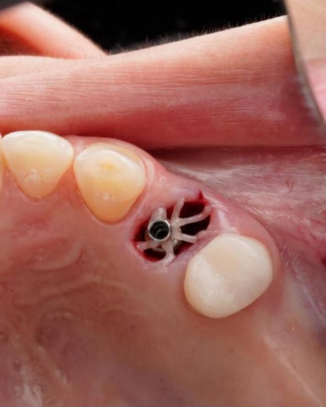 Why does my implant look like this? Wrong answers only.