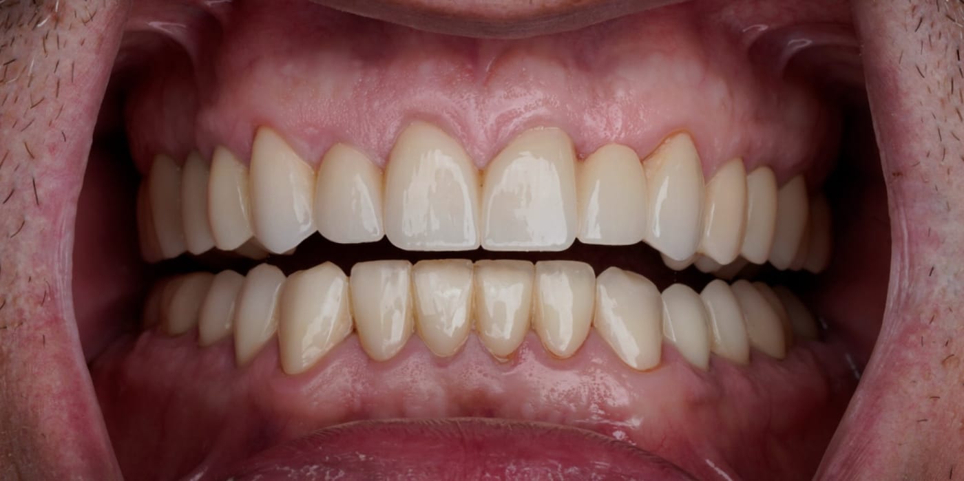 A complete smile makeover after years of neglect, after