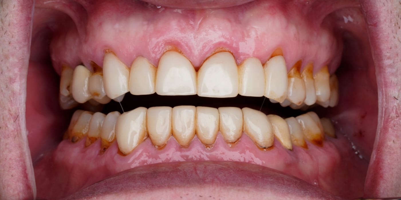 A complete smile makeover after years of neglect, before
